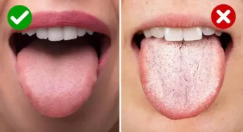 White tongue: when should you worry?